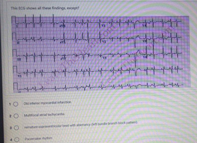 This ECG shows all these findings, except?
II
II
V1
10 Old inferior myocardial infarction
2 O Multifocal atrial tachycardia
3 0
remature supraventricular beat with aberrancy (left bundle branch block pattern).
Pacemaker rhythm
