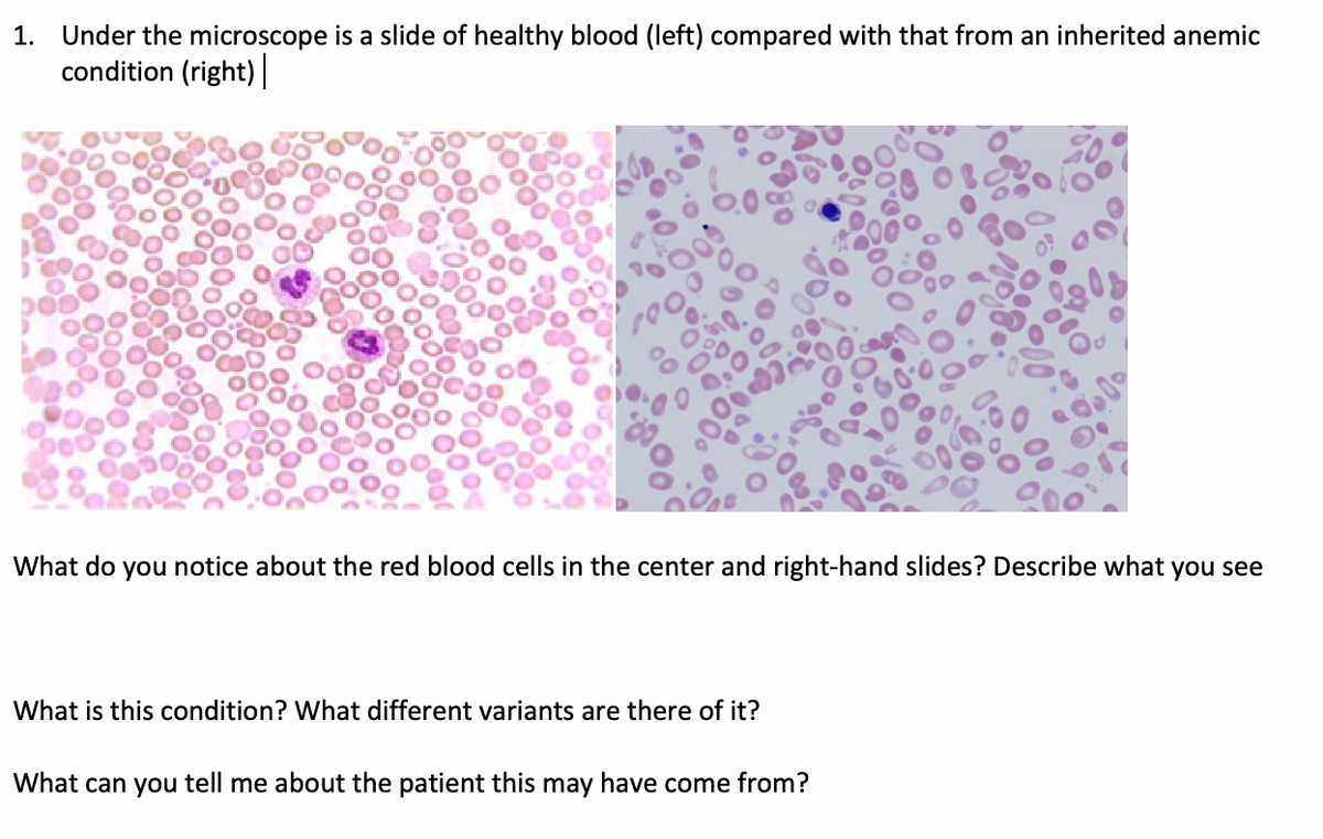 1. Under the microscope is a slide of healthy blood (left) compared with that from an inherited anemic
condition (right)|
What do you notice about the red blood cells in the center and right-hand slides? Describe what you see
What is this condition? What different variants are there of it?
What can you tell me about the patient this may have come from?
