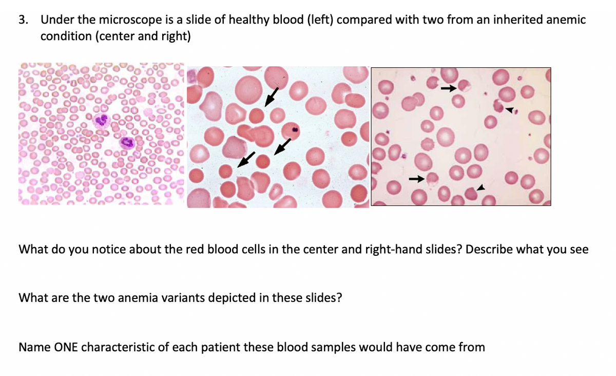 3. Under the microscope is a slide of healthy blood (left) compared with two from an inherited anemic
condition (center and right)
What do you notice about the red blood cells in the center and right-hand slides? Describe what you see
What are the two anemia variants depicted in these slides?
Name ONE characteristic of each patient these blood samples would have come from
