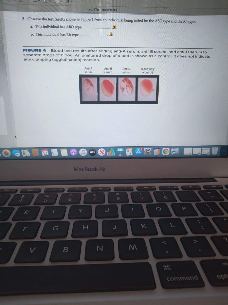 Lab. 27.pc (page 6 of 6)
5. Observe the test results shown in figure 4 from an individual being tested for the ABO type and the Rh type.
a. This individual has ABO type
2.
b. This individual has Rh type
FIGURE 4 Blood test results after adding anti-A serum, anti-B serum, and anti-D serum to
separate drops of blood. An unaltered drop of blood is shown as a control; it does not indicate
any clumping (agglutination) reaction.
Blood only
(control)
Anti-A
Anti-B
Anti-D
serum
serum
serum
stv
MacBook Air
24
%
&
7
8
4
5
Y
U
H.
K
F
B
alt
command
opt

