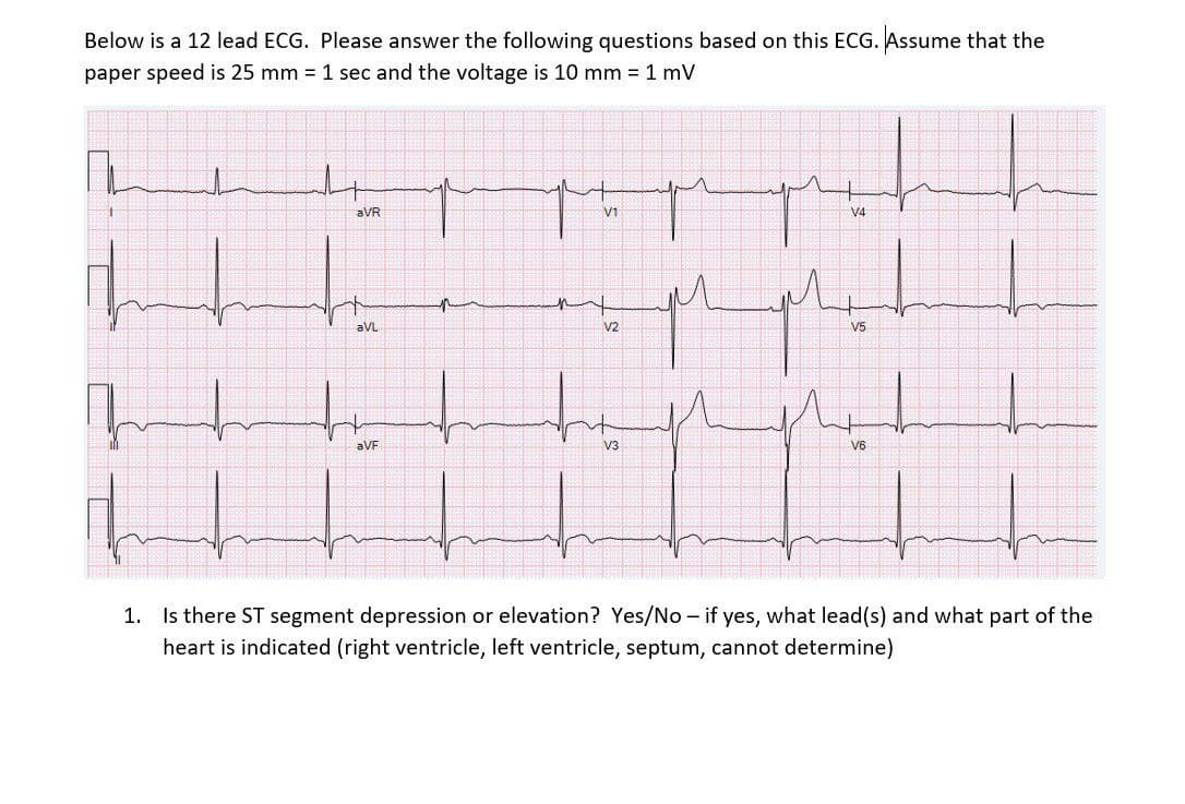 Below is a 12 lead ECG. Please answer the following questions based on this ECG. Assume that the
paper speed is 25 mm = 1 sec and the voltage is 10 mm = 1 mV
L
whe
aVR
aVL
aVF
V1
V2
V3
M
V4
V5
V6
1. Is there ST segment depression or elevation? Yes/No - if yes, what lead(s) and what part of the
heart is indicated (right ventricle, left ventricle, septum, cannot determine)
