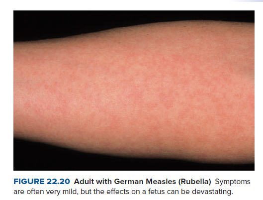 FIGURE 22.20 Adult with German Measles (Rubella) Symptoms
are often very mild, but the effects on a fetus can be devastating.
