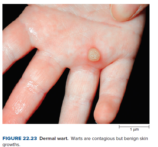 1 um
FIGURE 22.23 Dermal wart. Warts are contagious but benign skin
growths.
