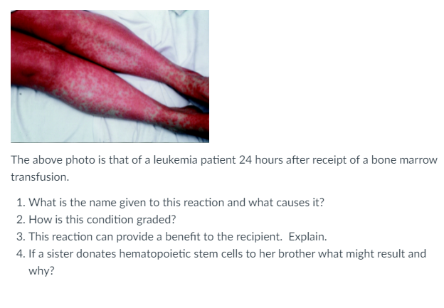 The above photo is that of a leukemia patient 24 hours after receipt of a bone marrow
transfusion.
1. What is the name given to this reaction and what causes it?
2. How is this condition graded?
3. This reaction can provide a benefit to the recipient. Explain.
4. If a sister donates hematopoietic stem cells to her brother what might result and
why?
