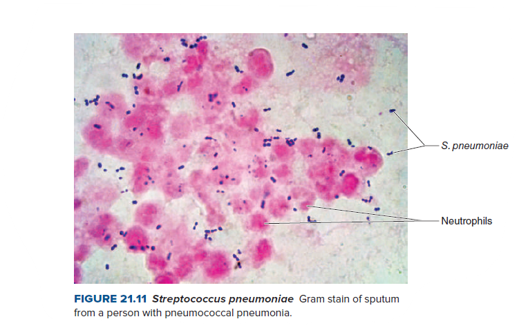 -S. pneumoniae
Neutrophils
FIGURE 21.11 Streptococcus pneumoniae Gram stain of sputum
from a person with pneumococcal pneumonia.
