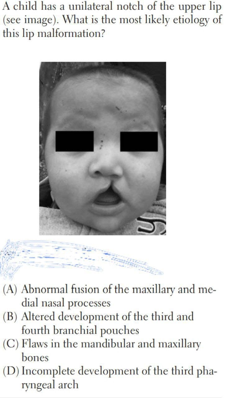 A child has a unilateral notch of the upper lip
(see image). What is the most likely etiology of
this lip malformation?
(A) Abnormal fusion of the maxillary and me-
dial nasal processes
(B) Altered development of the third and
fourth branchial pouches
(C) Flaws in the mandibular and maxillary
bones
(D) Incomplete development of the third pha-
ryngeal arch
