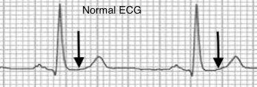 Normal ECG
