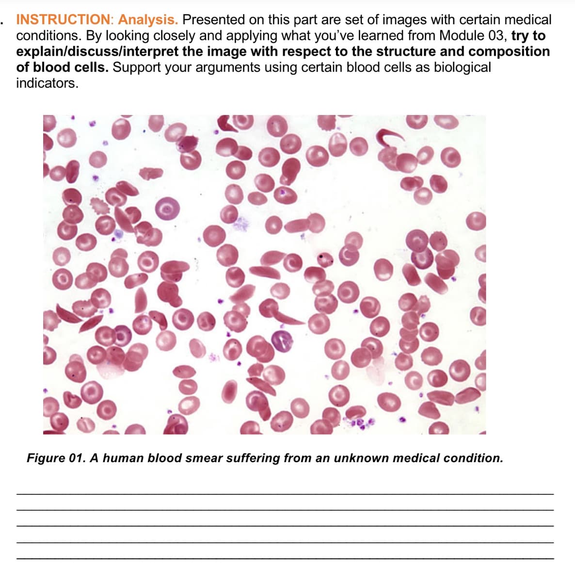 . INSTRUCTION: Analysis. Presented on this part are set of images with certain medical
conditions. By looking closely and applying what you've learned from Module 03, try to
explain/discuss/interpret the image with respect to the structure and composition
of blood cells. Support your arguments using certain blood cells as biological
indicators.
Figure 01. A human blood smear suffering from an unknown medical condition.
