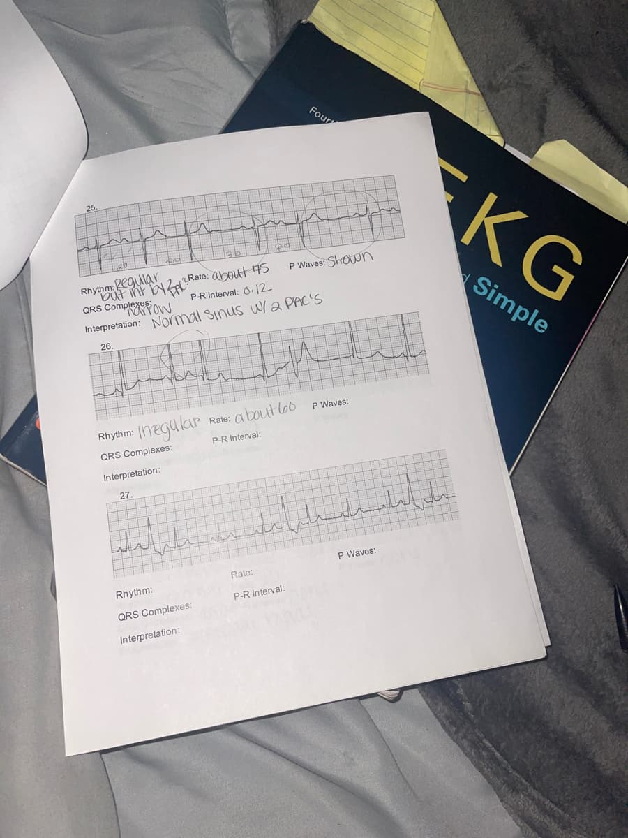 Four
Rhythm: Regular
but int by AS Rate: about 175
QRS Complexow
P-R Interval: 0.12
Interpretation: Normal Sinus W/ 2 PAC'S
26.
P Waves:
Rate: about loo
Rhythm: Irregular
P-R Interval:
QRS Complexes:
Interpretation:
27.
Rhythm:
QRS Complexes:
Interpretation:
P Waves: Shown
سلسلة لتلسيسيليا
Rate:
P-R Interval:
P Waves:
KG
Simple